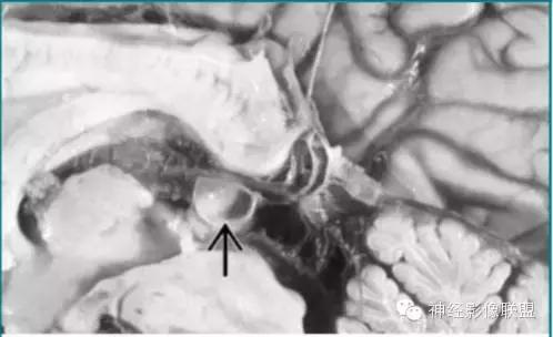 各种囊肿的症状,颅内囊肿18-19mm严重吗