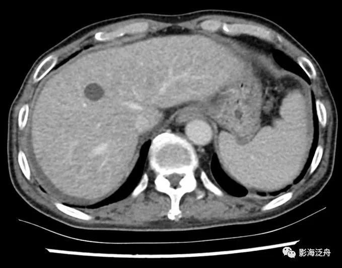 肝脏弥漫性病变严重吗,肝脏弥漫性的病变的症状