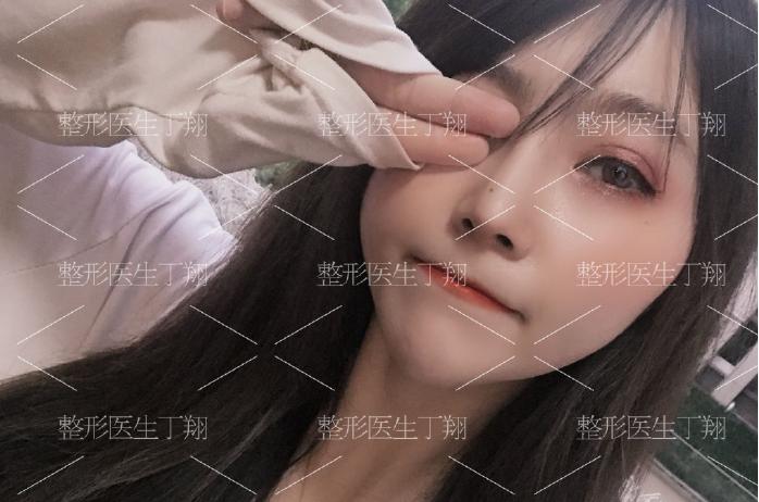 丁翔做隆鼻技术怎么样,美之峰丁翔