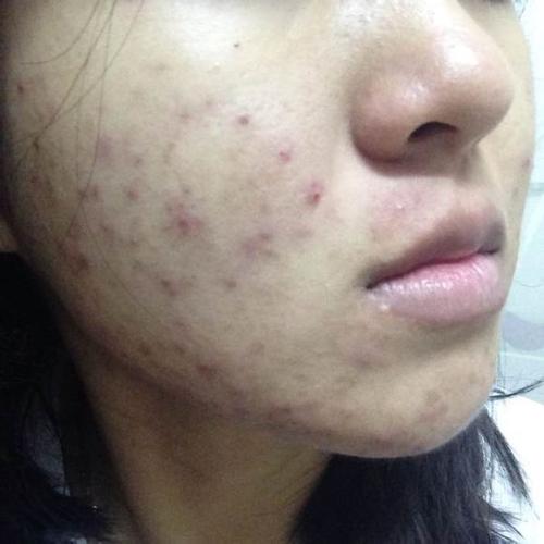 毛孔被挤大怎么办,脸部被挖破怎么简单处理不留疤