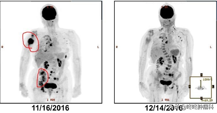 her2肺癌有靶向药吗,肺癌her2靶向药