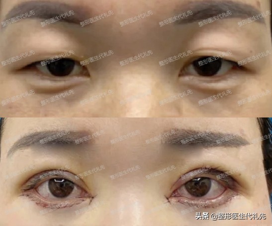 做了外切眼袋怎么消肿最快,内切去眼袋下眼睑外翻