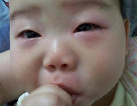 宝宝眼睛疼警惕四种疾病,7个月宝宝眼睛发红该怎么办