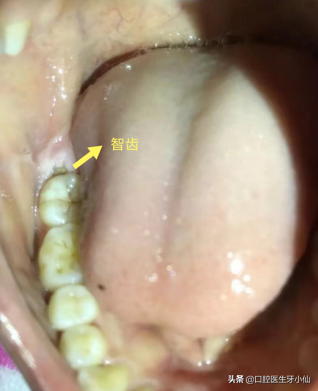 新冠期间智齿发炎肿痛怎么办,新冠期间智齿肿痛吃啥药