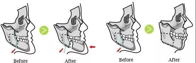 地包天科普主题,孩子地包天的治疗方法