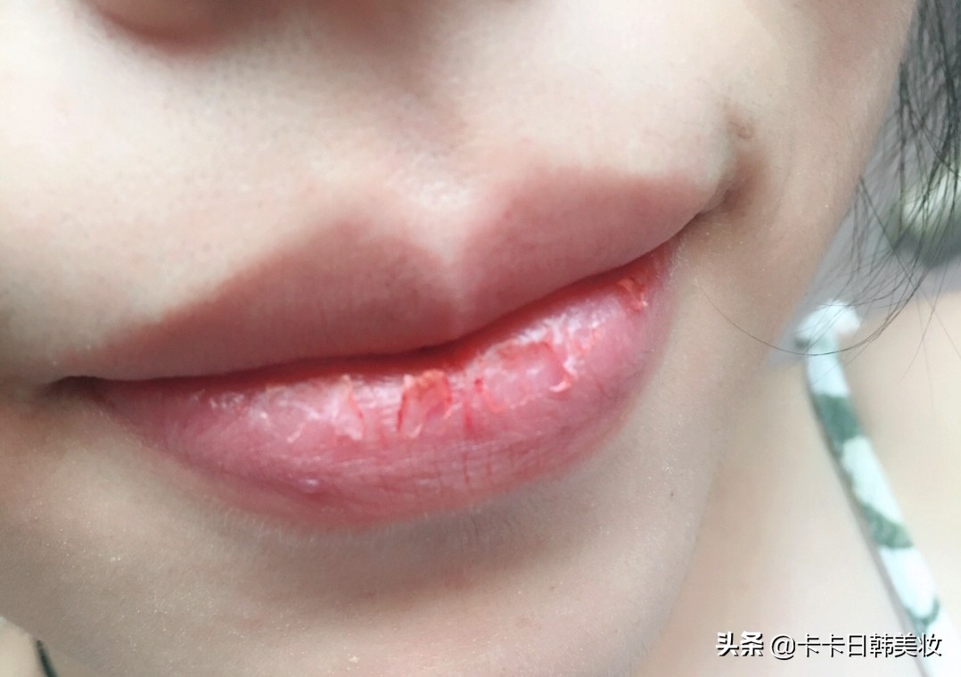 唇纹深嘴唇干裂起皮小妙招,嘴唇干燥脱皮唇纹深用什么唇膏好