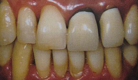 烤瓷牙戴了几年，牙根发黑，不痛不痒还能继续用吗？该怎么处理？