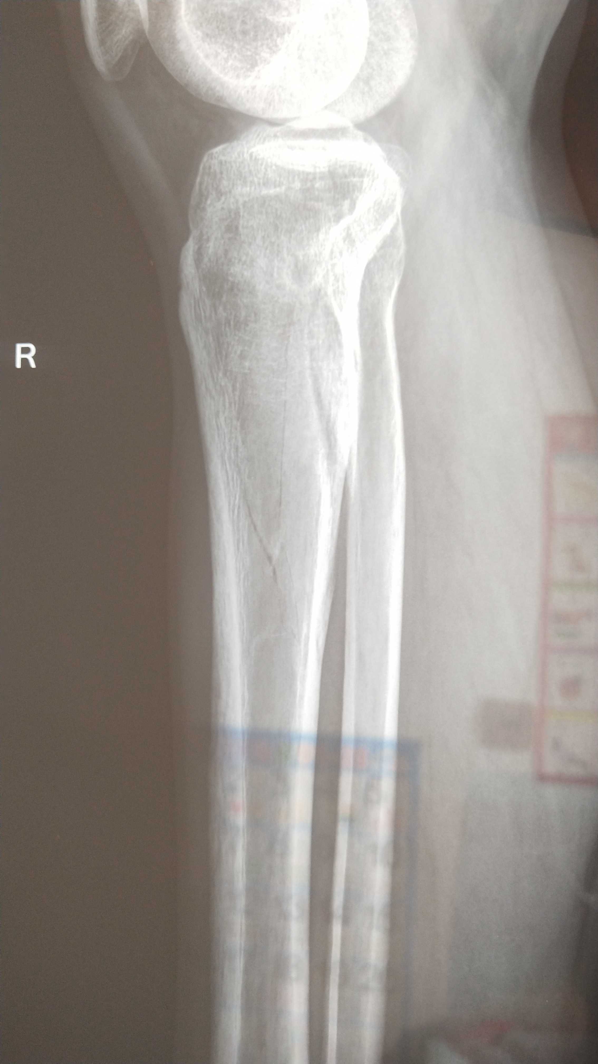 胫骨平台骨折复位不理想怎么办,胫骨粉碎骨折多久才会痊愈