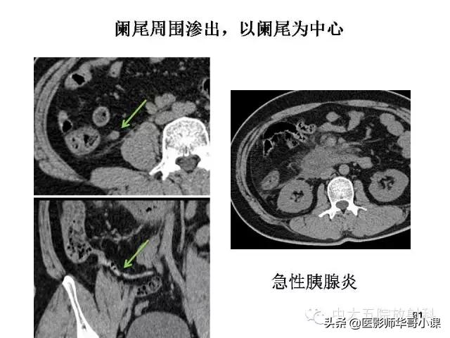 阑尾炎课件,阑尾炎的超声课件