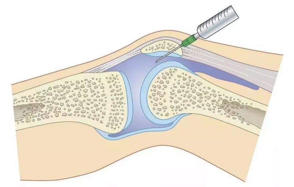 膝盖有骨刺和关节炎怎么治疗最好,膝关节长骨刺一冷就疼怎么治疗