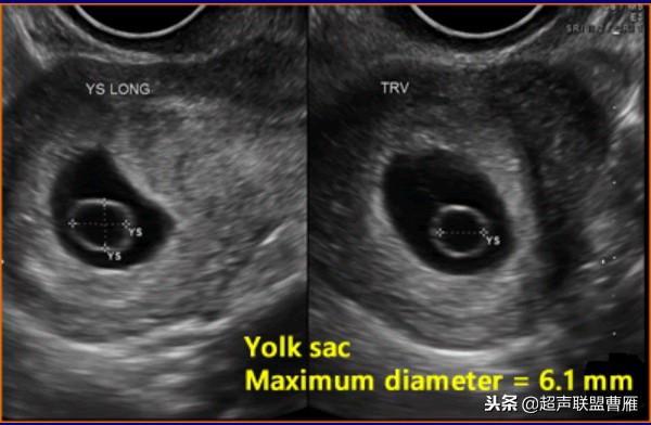 3毫米卵黄囊未见胎芽正常么,40多天的卵黄囊