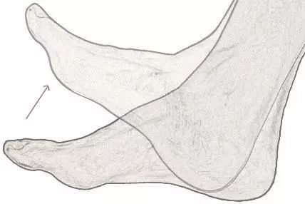 脑梗下肢划圈如何恢复,脑梗走路画圈还抬胯