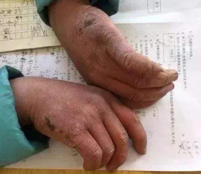 满头冰花的男孩,如今的冰花男孩