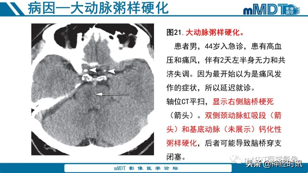 急性缺血性脑卒中ppt素材图片,青年缺血性脑卒中ppt