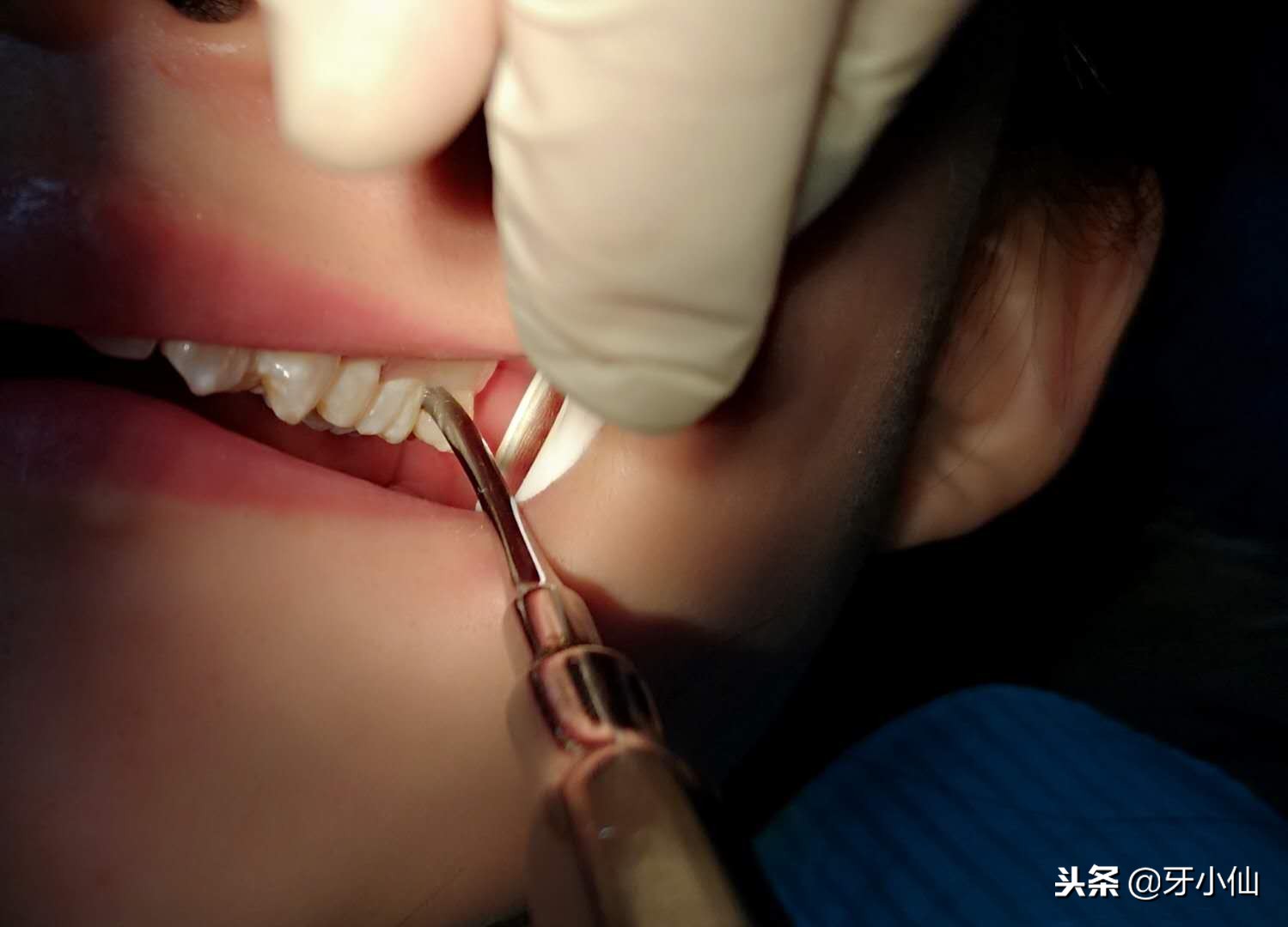 拔牙疼不过三秒,亲身经历告诉你拔牙到底痛不痛