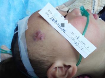 混合型血管瘤的治疗办法,混合型血管瘤的最佳治疗方法