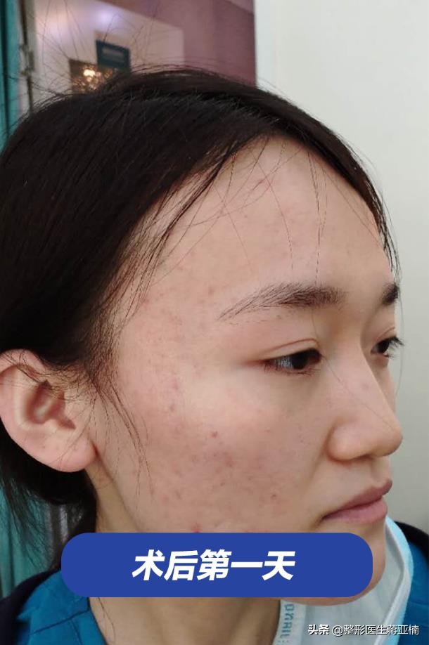 青春不留痘祛痘效果好吗,青春不长痘