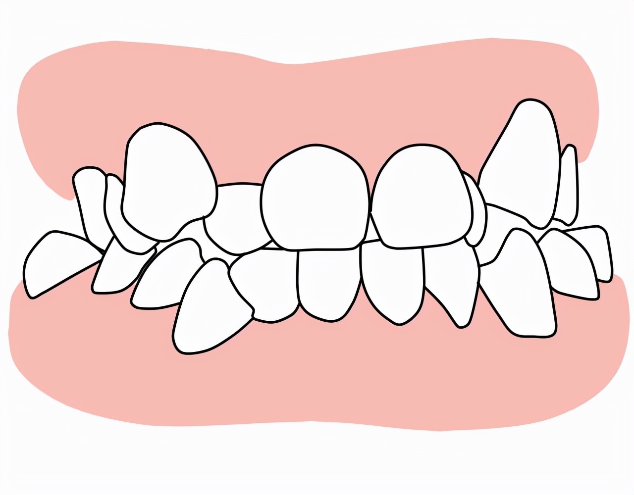 牙齿拥挤要进行治疗吗,孩子牙齿拥挤需要拔吗