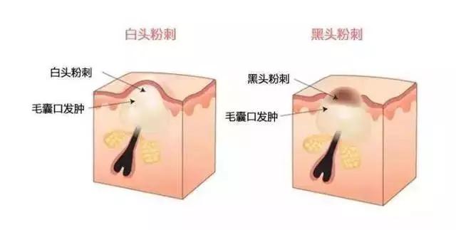 痤疮和粉刺适合用维a酸乳膏吗,维a酸类治疗痘痘效果怎么样