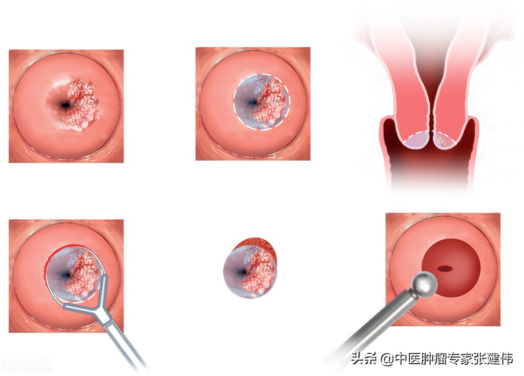 tct宫颈癌筛查报告单,2023年tct宫颈癌报告单