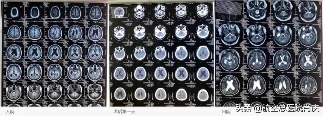 脑积水分流术是否能治好脑积水,脑积水头晕怎么处理