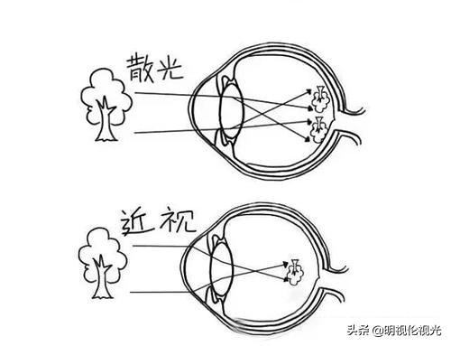 散光的感觉跟近视的感觉一样嘛,散光的度数可以加到近视里面吗