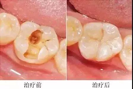 不做根管治疗直接补牙有什么危害,牙疼根管治疗后还疼什么原因