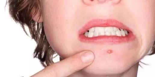 闭合性粉刺的正确消除方法,阿司匹林祛除闭合性粉刺