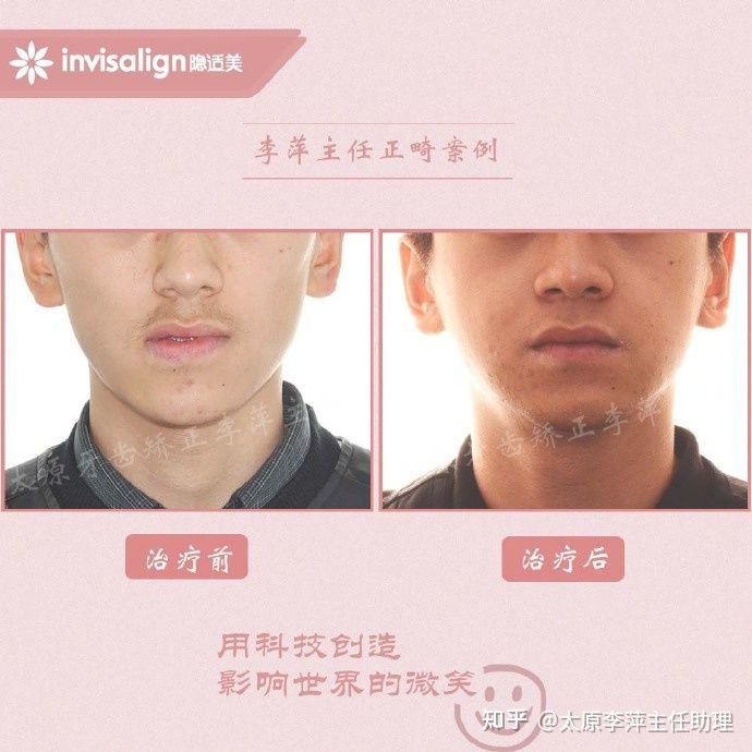 太原矫正牙齿需要做正颌吗,太原牙齿二次矫正