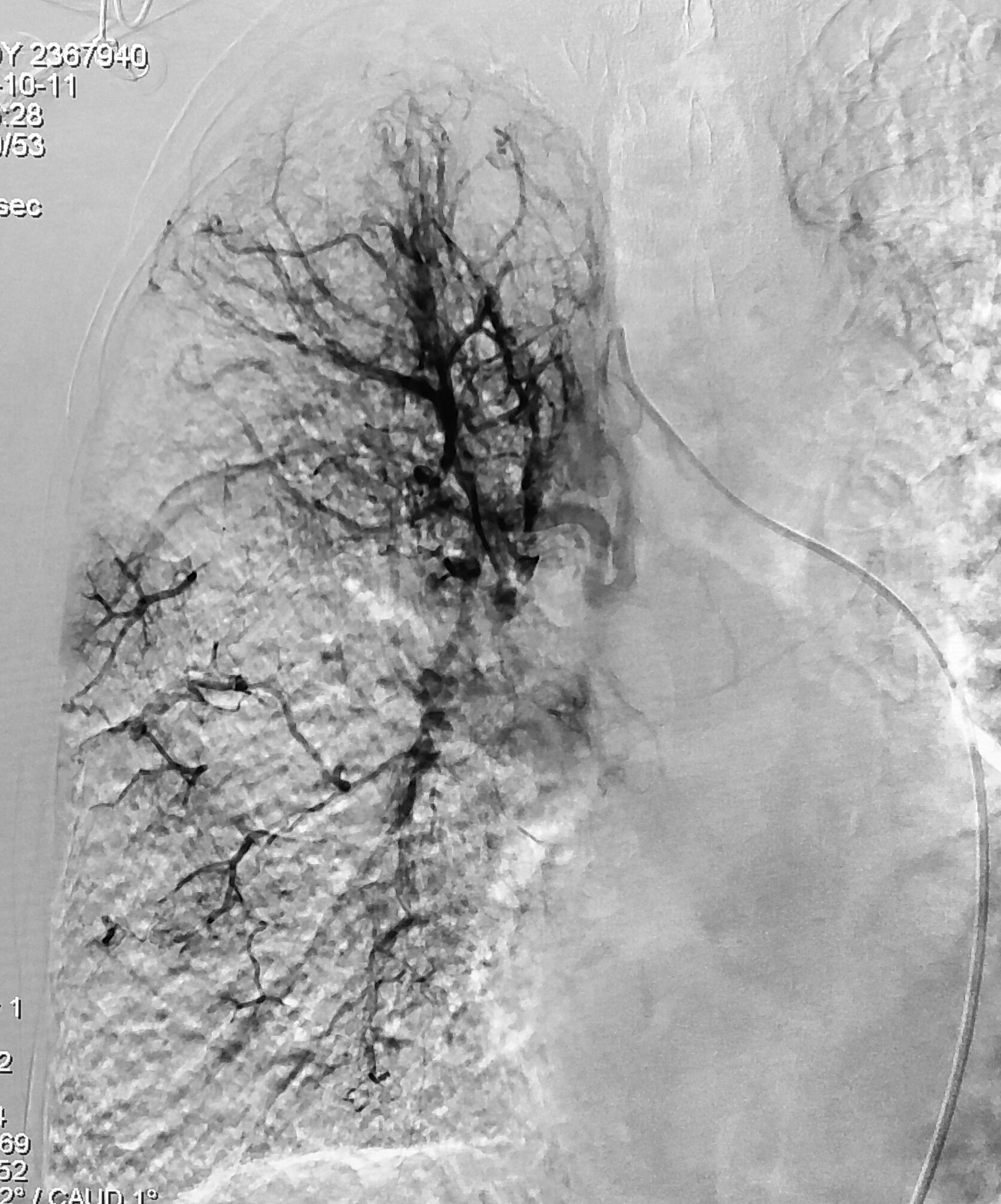 80岁老人咳血怎么办,90岁老人肺癌晚期咳血能活多久