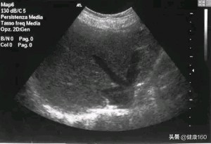 B超三维和四维彩超的区别,三维b超跟四维彩超的区别