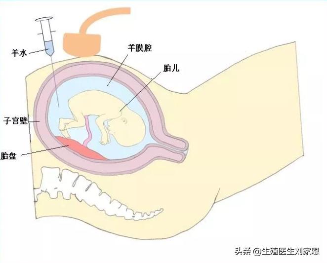 孕期检查什么情况必须做羊水穿刺,无创和羊水穿刺检查项目区别