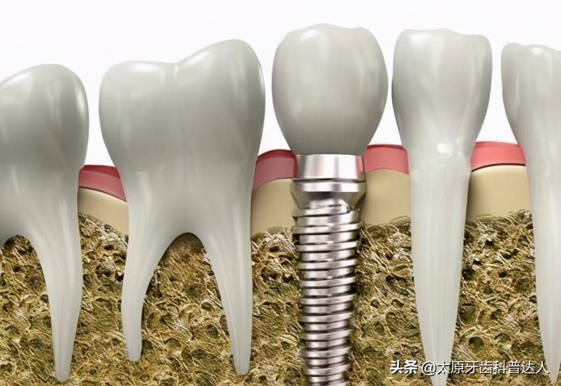 种植牙的五大误区,种植牙也有宿敌这些习惯需警惕