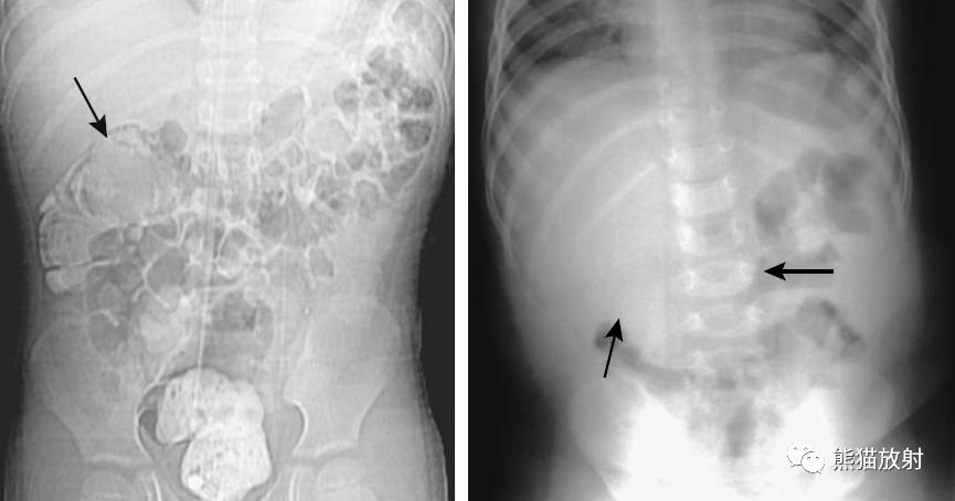 腹部影像图片大全,乙状直肠疼痛位置图片
