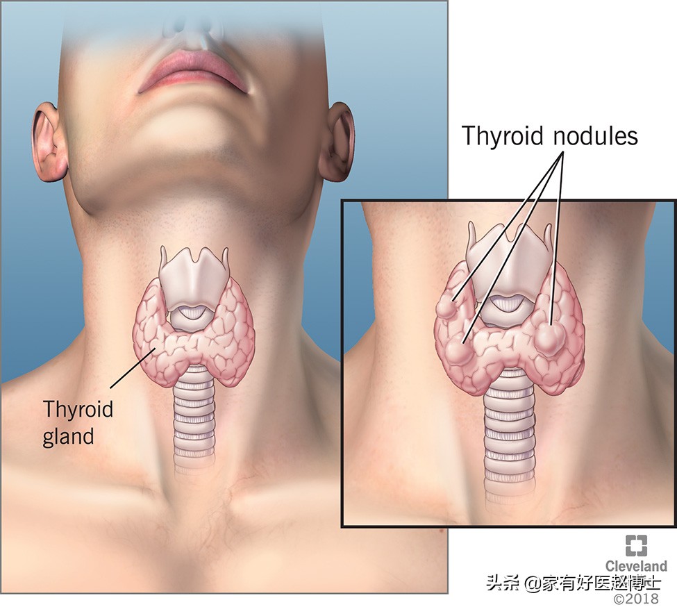 体检报告中常出现钙化哪些需警惕,钙化有什么症状和危害