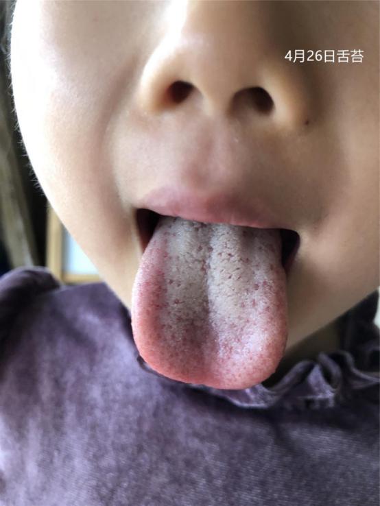 小孩胃积食口臭磨牙怎么办,孩子磨牙是积食还是胃热