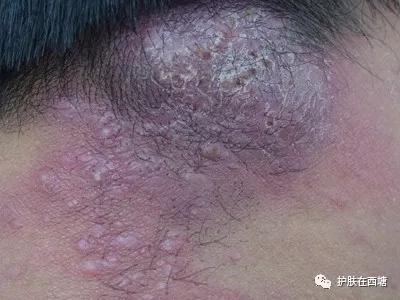 链球菌感染导致皮肤病,革兰氏阳性球菌皮肤病