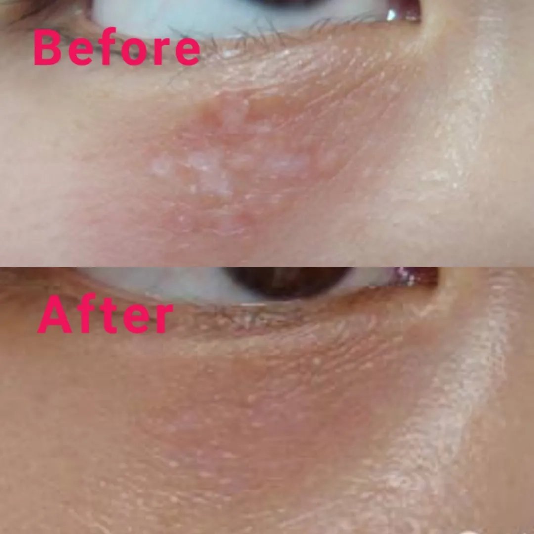 护肤界有名的难缠小妖精，现在搞定它