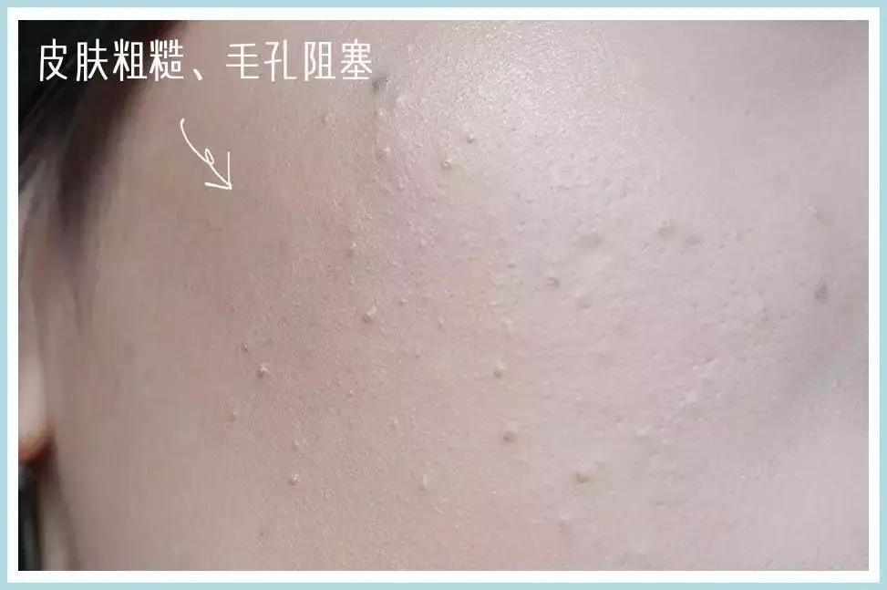 什么肤质适合刷酸美白,什么肤质适合刷酸