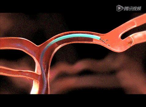 脑血管的清道夫——神奇取栓术