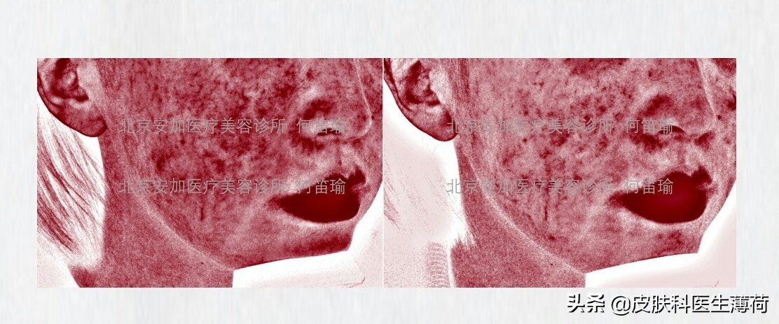 敏感肌修护医生,敏感肌表皮敏感和深层敏感