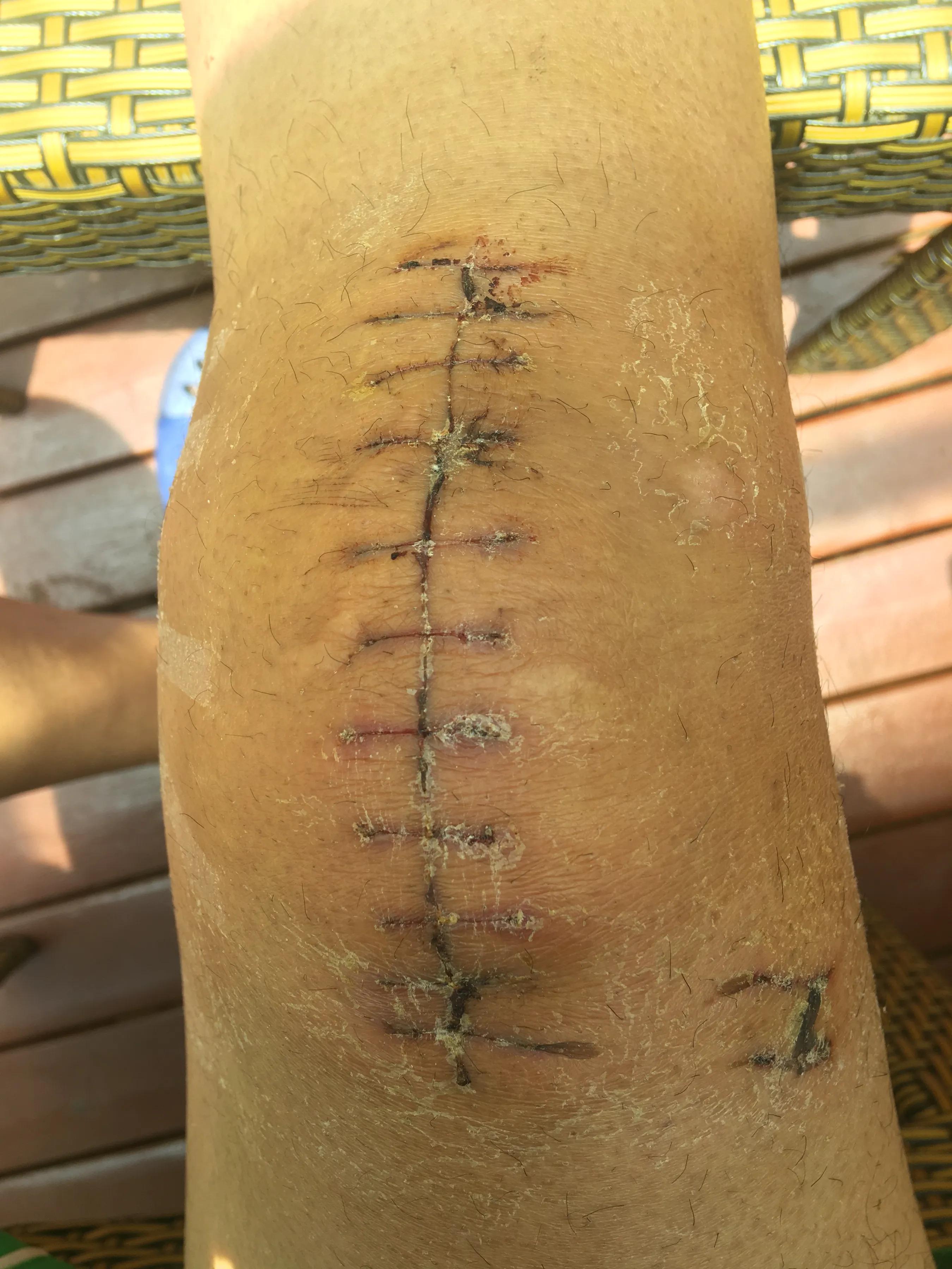 髌骨骨折取内固定费用多少,髌骨骨折保守治疗后的康复训练