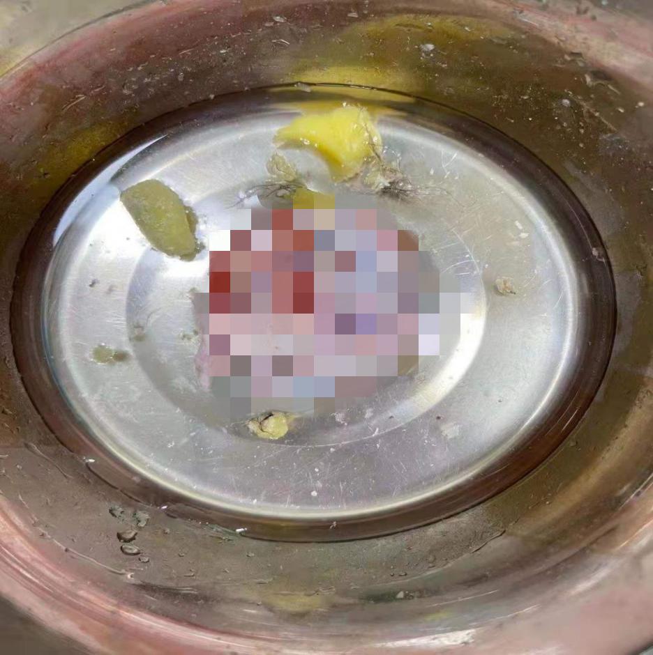 【技术】妇科无痕腔镜手术在南昌大学二附院妇产科成熟开展