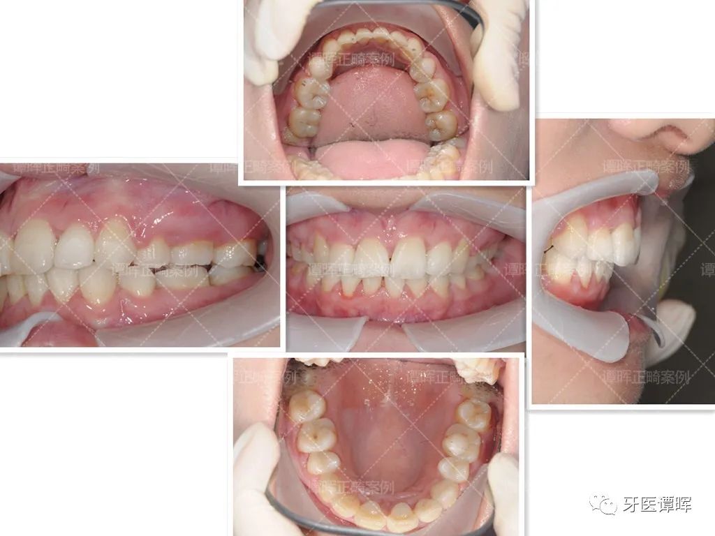 门牙前突+牙齿不齐矫正案例分享