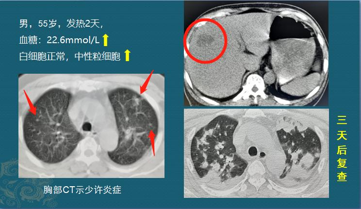 糖尿病人不要犟,有1种细菌喜欢喝糖浆,感染眼睛会失明