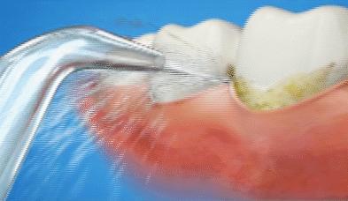 牙缝1cm太大医生说补不了,牙缝上面细下面大能补吗