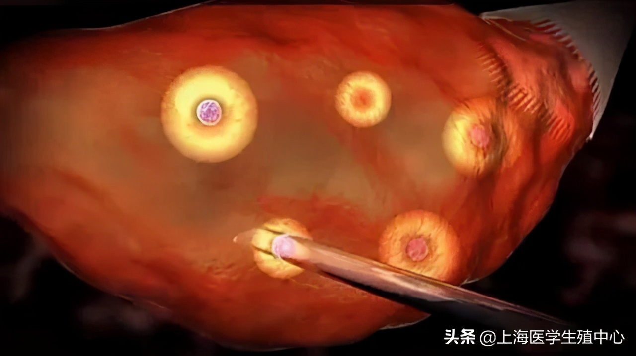 试管婴儿取完卵防止腹水,试管婴儿取完卵怎么调养身体