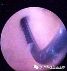 输卵管造影通而不畅怎么治疗,输卵管通而不畅医生如何诊断