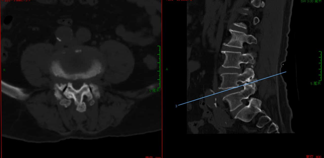 腰椎管狭窄症手术好么,腰椎管狭窄手术和保守治疗哪个好