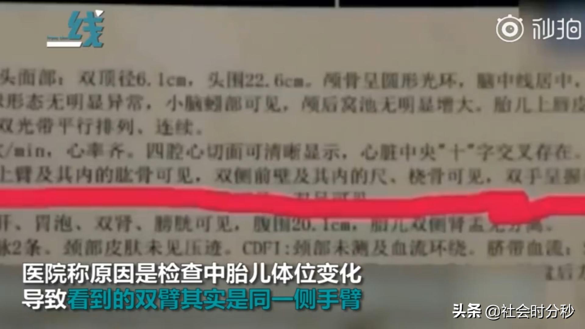 产检中发现胎儿手指缺失,孕检没查出来孩子生下来手指缺陷